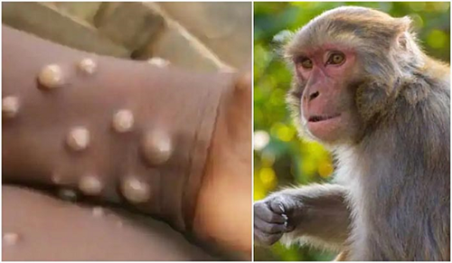 Thông tin sai lệch về các ca mắc bệnh đậu mùa khỉ