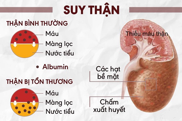 6. Phương pháp điều trị suy thận