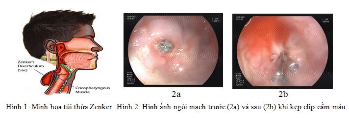 Túi 2025 thừa zenker