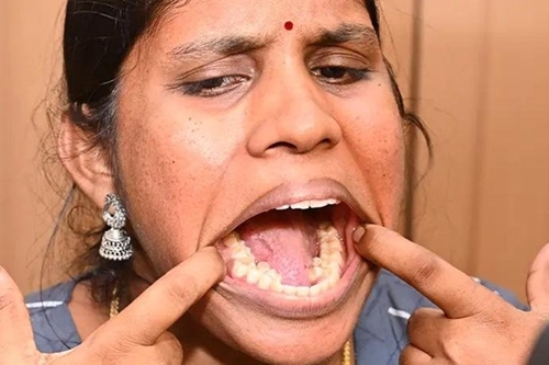 Người phụ nữ mọc nhiều răng nhất thế giới