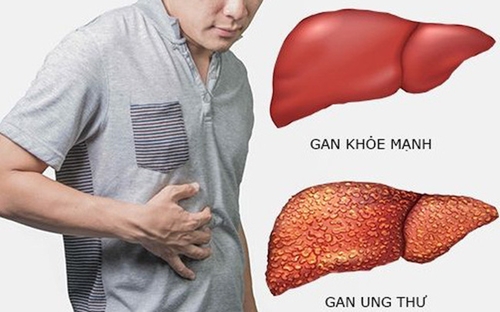 Việt Nam ghi nhận hơn 26 000 trường hợp ung thư gan mỗi năm