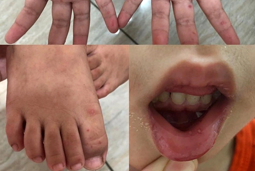 Số ca mắc bệnh chân tay miệng gia tăng tại nhiều địa phương